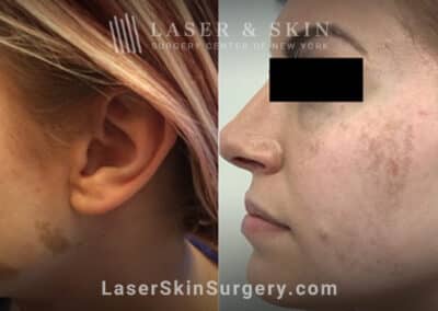 Ruby laser treatment for Café au Lait macules on cheek