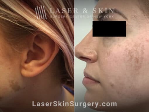 Ruby laser treatment for Café au Lait macules on cheek