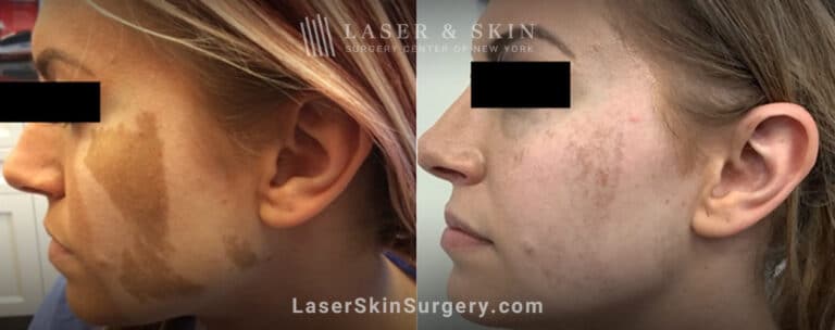 Ruby laser treatment for Café au Lait macules on cheek