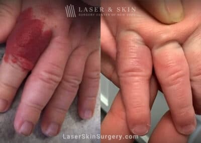 Vbeam laser used to remove hemangioma from infant’s finger