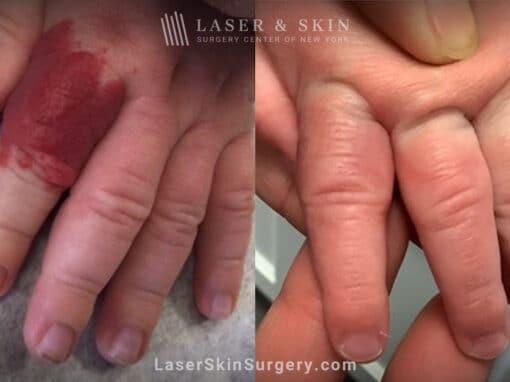 Vbeam laser used to remove hemangioma from infant’s finger