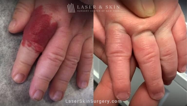 Vbeam laser used to remove hemangioma from infant’s finger