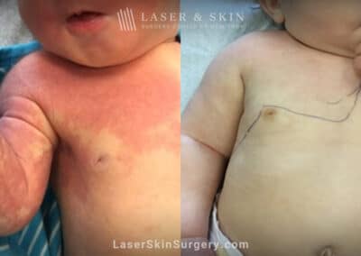 Vbeam laser to treat port wine birthmark