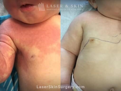 Vbeam laser to treat port wine birthmark