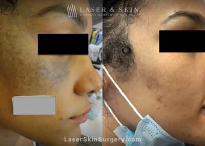 ND:YAG laser to treat nevus of ota birthmark