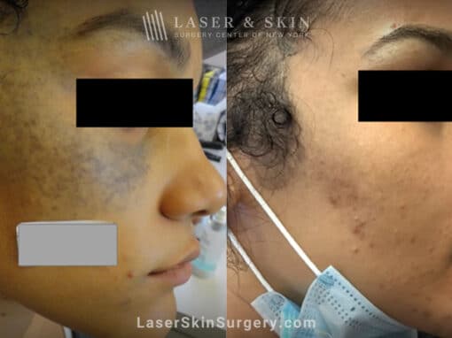 ND:YAG laser to treat nevus of ota birthmark