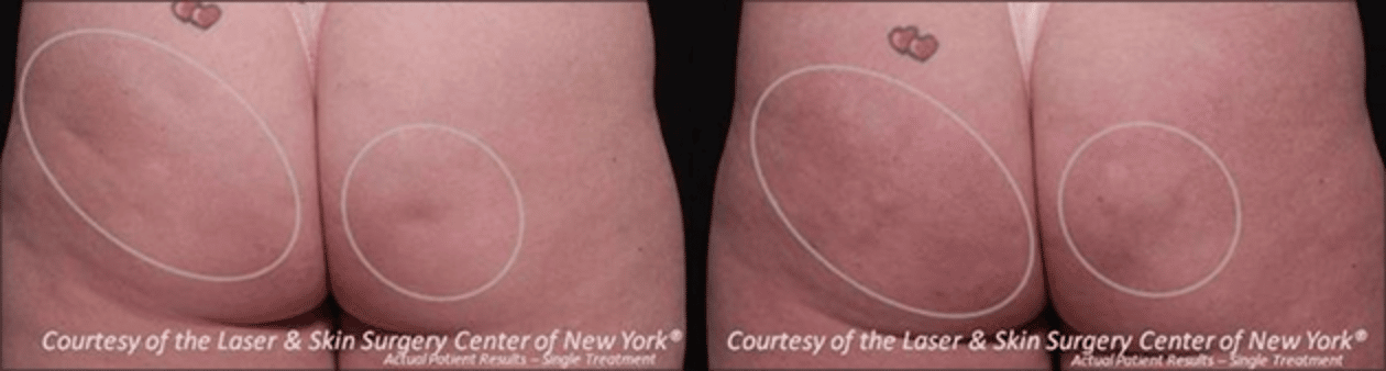 before and after image of cellulite treatment results with Cellfina in NYC, NY