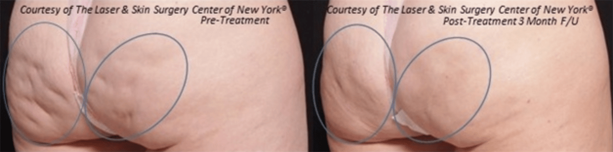 before and after image of cellulite treatment from skin care clinic in New York City