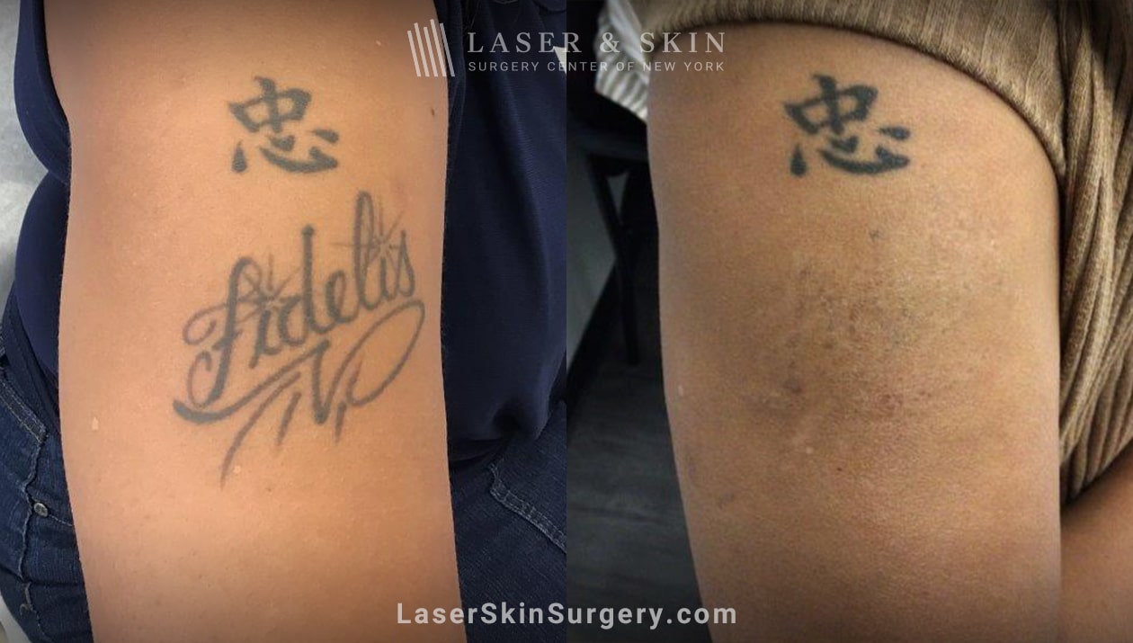 laser tattoo removal-New York-NY laser tattoo removal results on patient arm in NYC