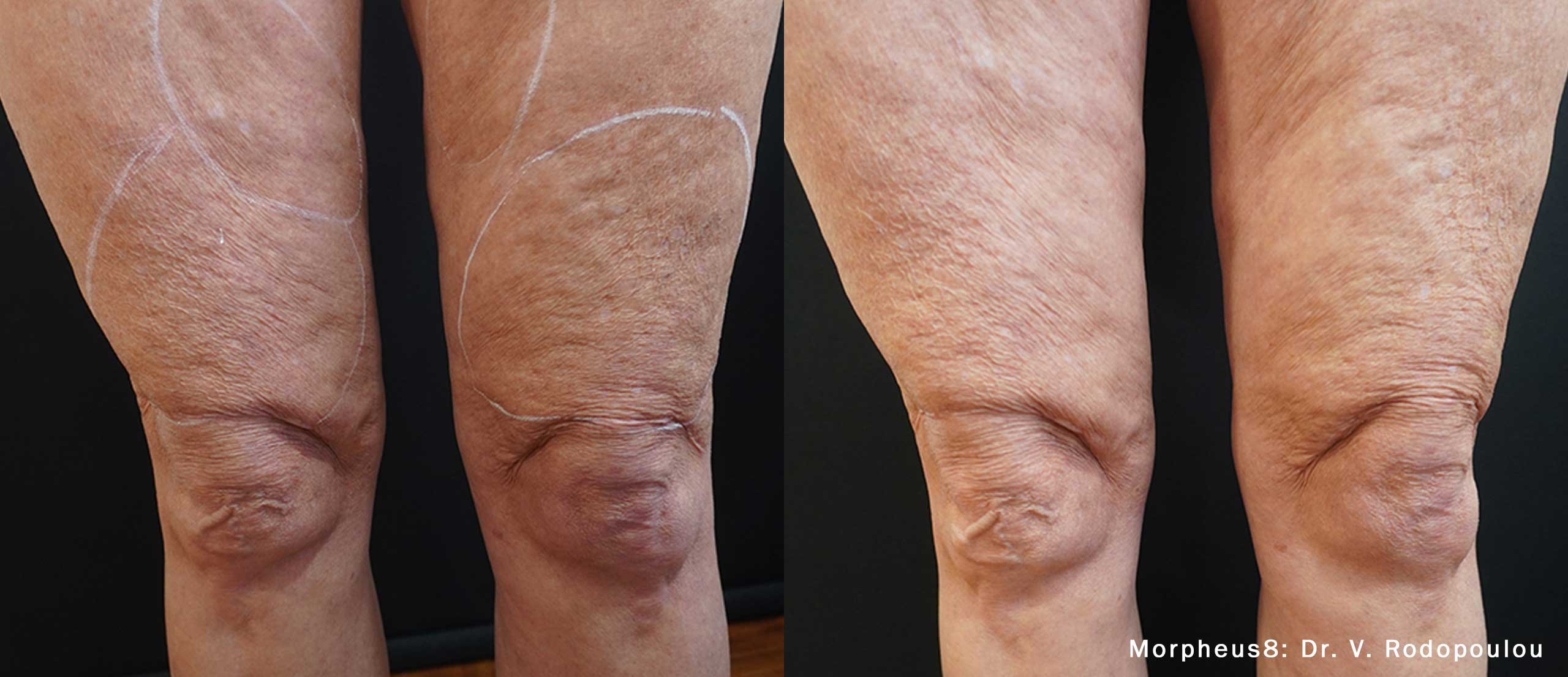 morpheus8 recovery time-New York-NY Morpheus8 treatment results on NYC patient