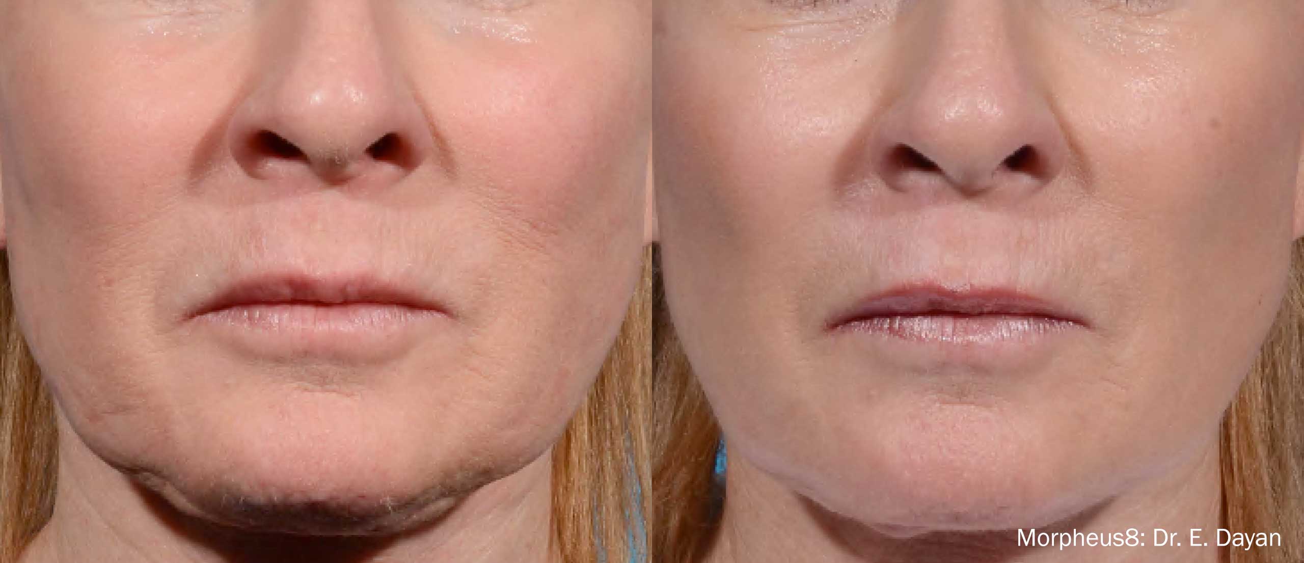 before and after results a patient's Morpheus8 treatment in NY, NY