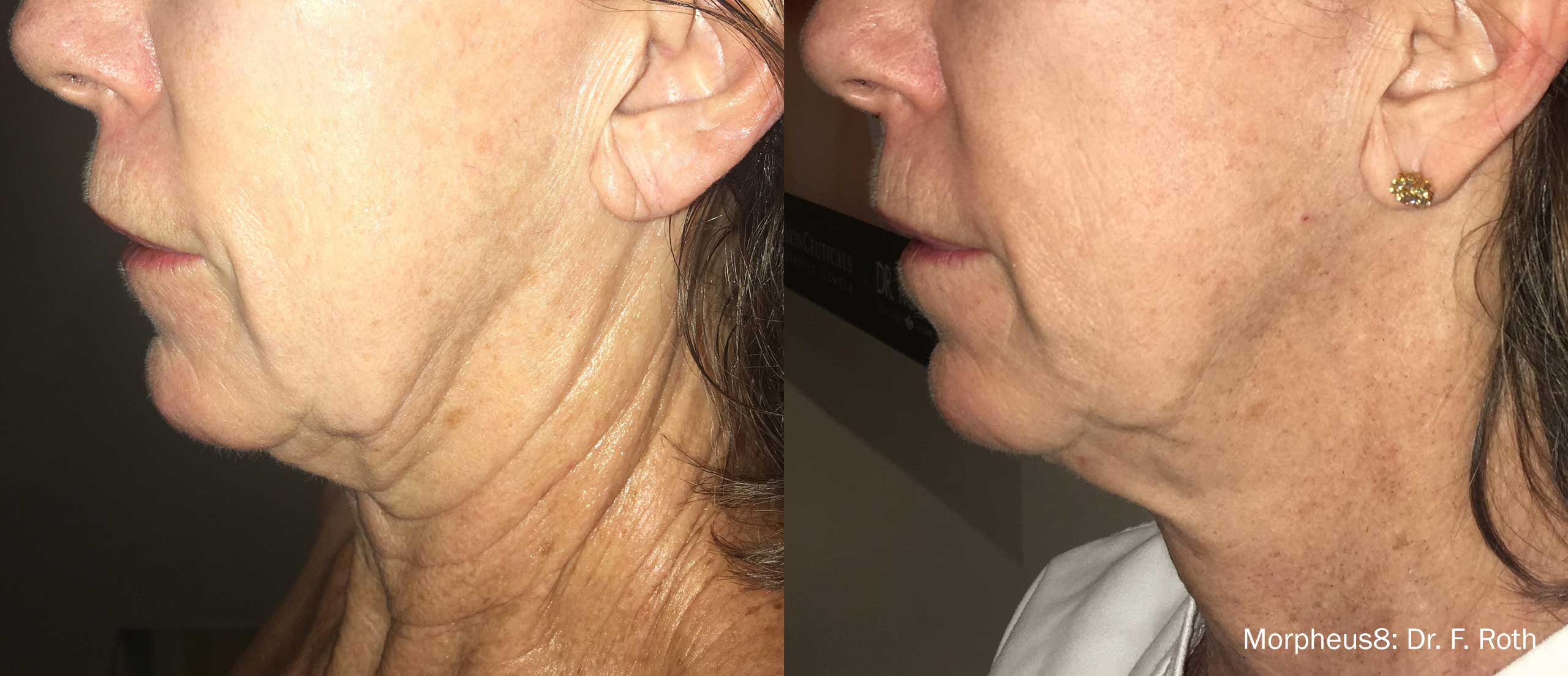 sagging skin treatment-morpheus8-NYC-NY Morpheus8 microneedling RF results on a New York City patient
