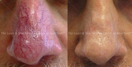 Two images comparing a man's nose before and after the treatment for broken vessels, the unwanted vessels are gone and the nose looks normal, NYC, NY. 