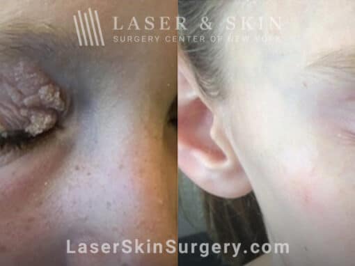 Laser treatment for Epidermal Nevus around eye using the Erbium laser