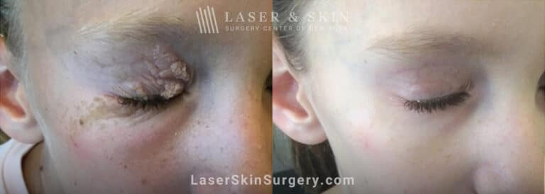 Laser treatment for Epidermal Nevus around eye using the Erbium laser