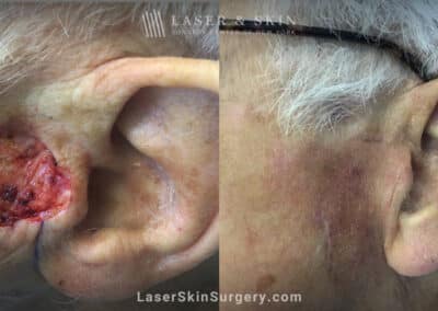 Mohs to treat skin cancer in front of ear