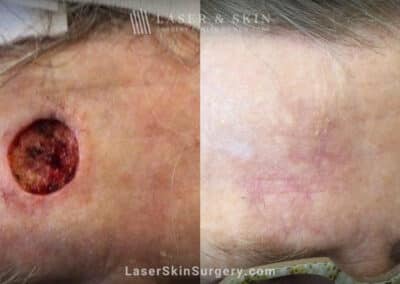 Mohs surgery to treat skin cancer on forehead