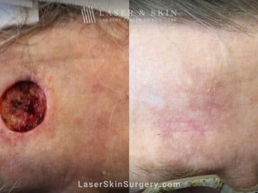 Mohs surgery to treat skin cancer on forehead