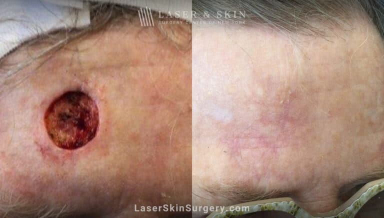 Mohs surgery to treat skin cancer on forehead