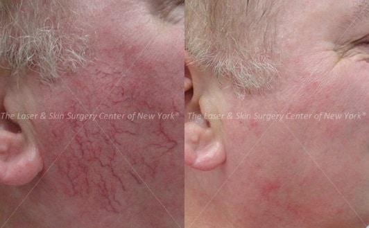 Pikiloderma Treatment in NYC, NY. Before and After photos of face of a man after laser treatment for Poikiloderma, A type of sun damage on neck and chest.