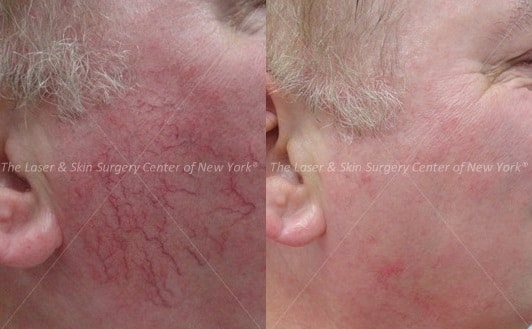 Before and After photos of face of a man after laser treatment for Poikiloderma, A type of sun damage on neck and chest.