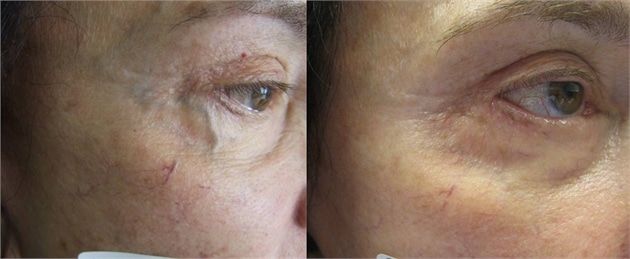 Telangiectases treatment in NYC, NY. Images comparing eyelids of an older woman before and after treating Telangiectases in NYC, NY. Telangiectases are enlarged blood vessels that occur in all parts of the body, but most commonly on the face.