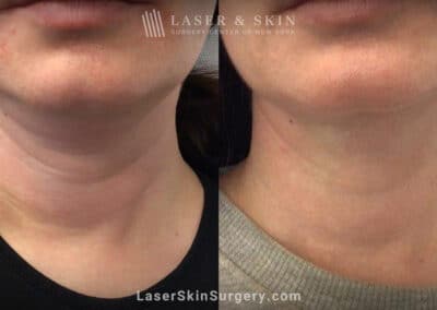ThermiTight for Neck Rejuvenation