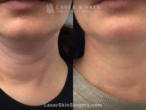 ThermiTight for Neck Rejuvenation