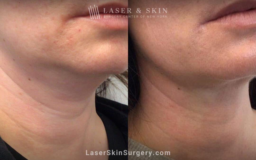 rf microneedling for neck rejuvenation