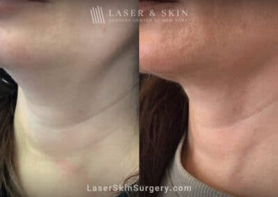 ThermiTight for Neck Rejuvenation