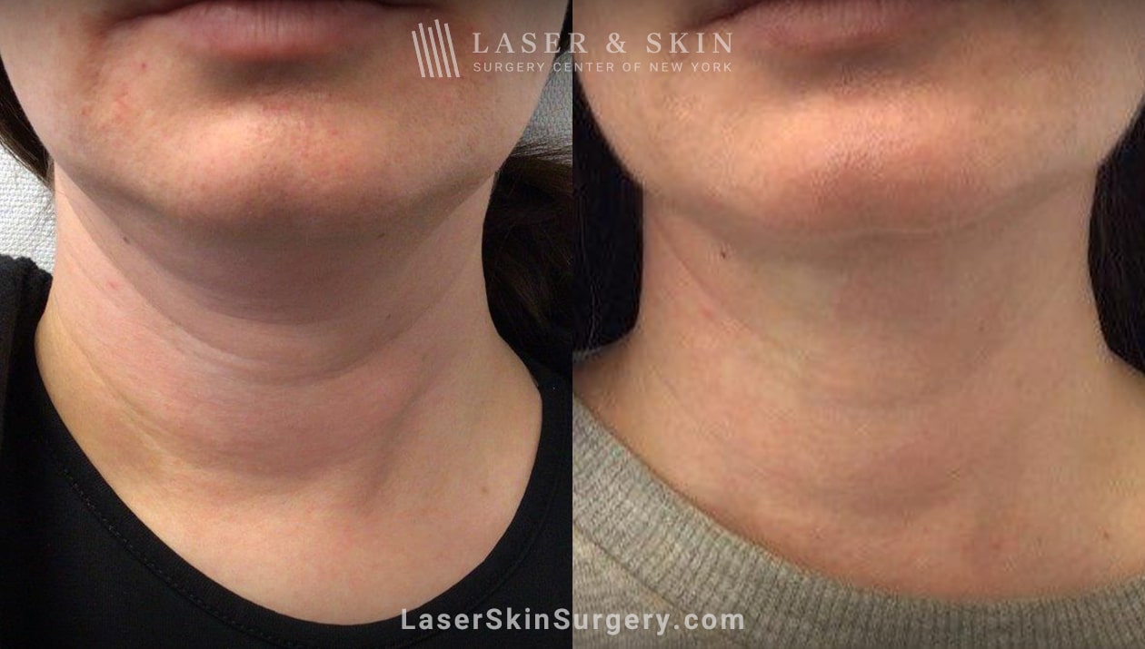 ultherapy treatment results patient results before and after ultherapy treatment
