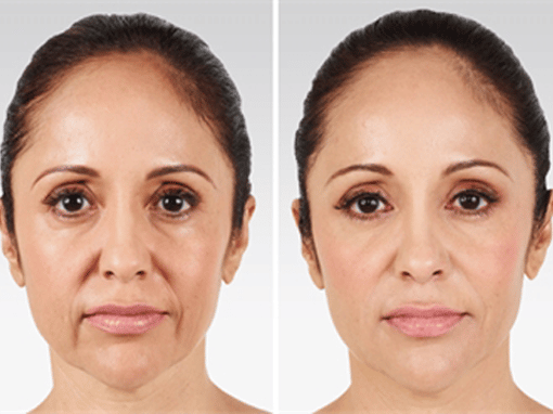 Treatubg skin laxity in NYC, NY Images comparing face of a middle aged woman before and after her treatment for sagging skin in NYC, NY.