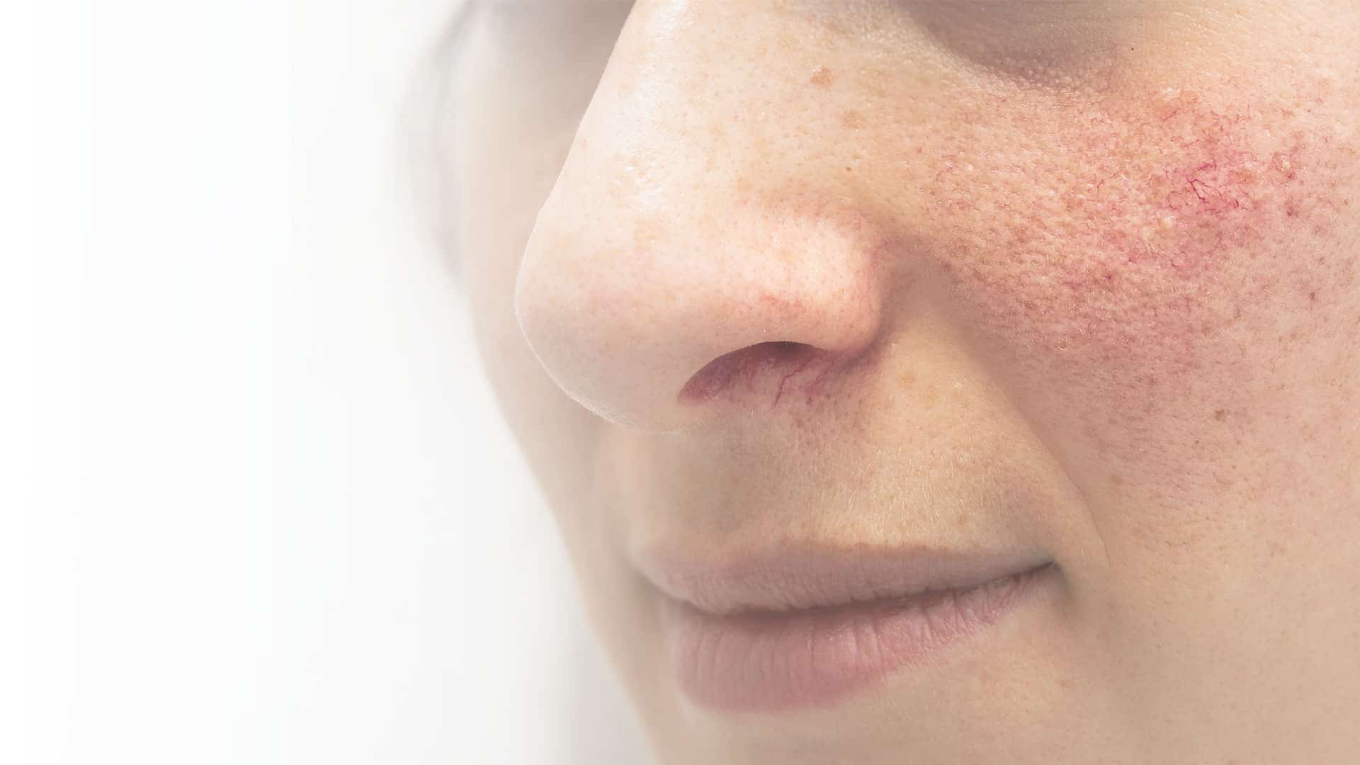 Close up on a woman's face with roscea, NYC, NY.