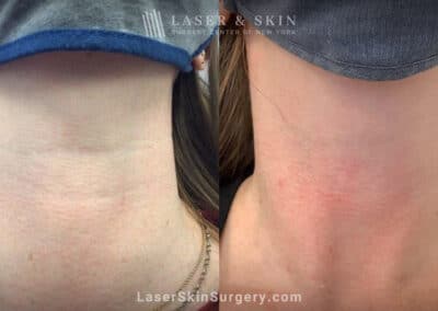 Belotero filler injections to reduce horizontal banding on the neck