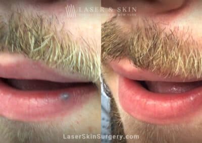 Excel V laser used to treat venous lake on man’s lip