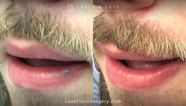 Excel V laser used to treat venous lake on man’s lip