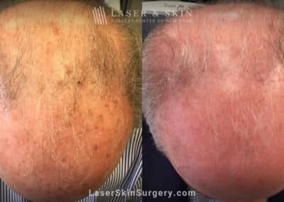 Fraxel laser used to treat sun damage on man’s scalp