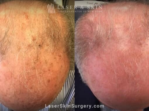 Fraxel laser used to treat sun damage on man’s scalp