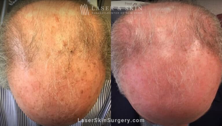 Fraxel laser used to treat sun damage on man’s scalp