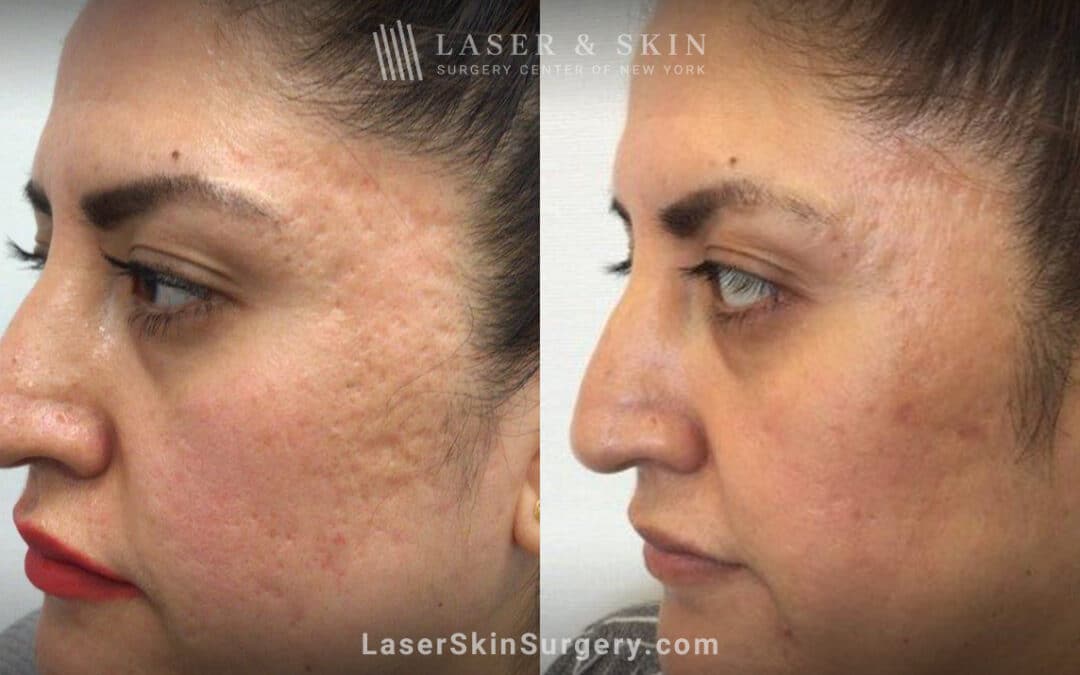 Genius microneedling to treat acne scarring – after three treatments