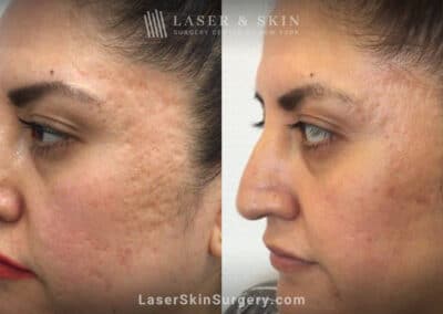 Genius microneedling to treat acne scarring – after three treatments