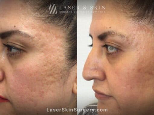 Genius microneedling to treat acne scarring – after three treatments