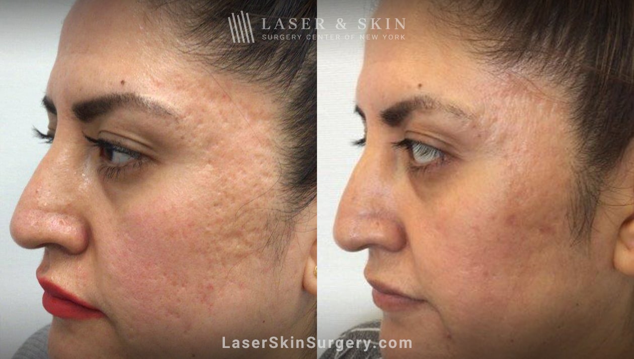 laser acne scar removal before and after in new york