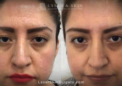 Genius microneedling to treat acne scarring – after three treatments