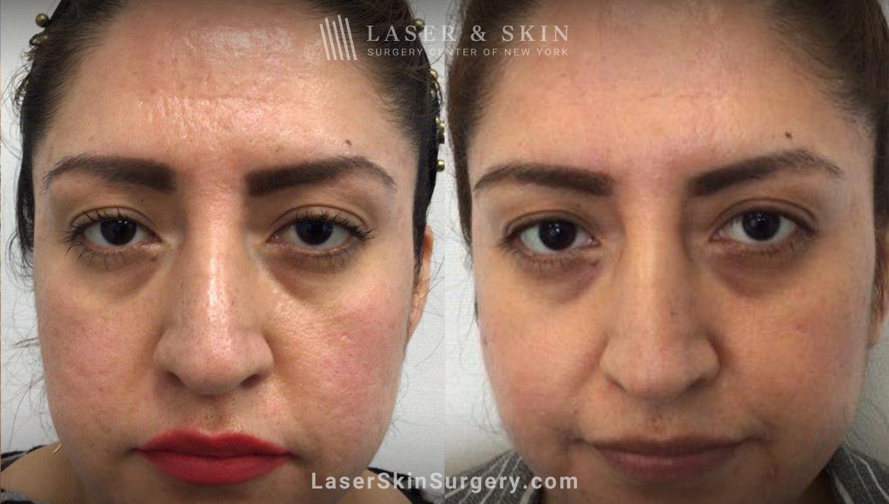 Dermal Fillers Help Reverse Acne Scars