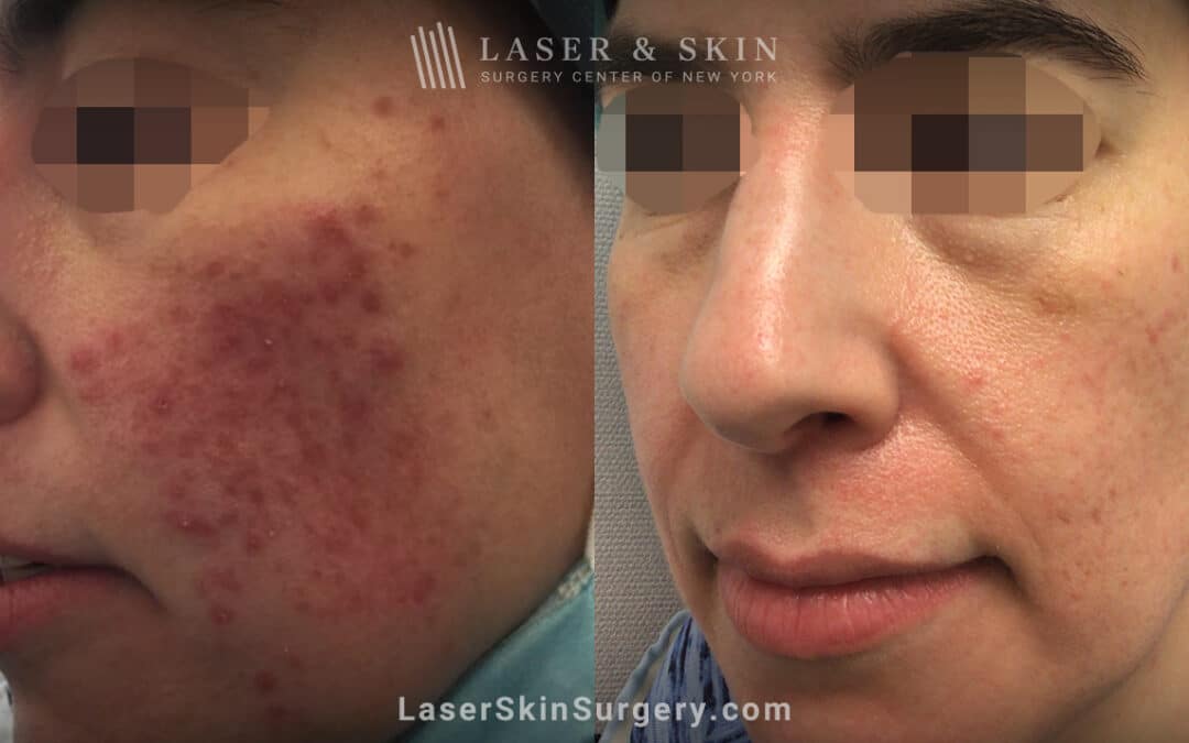 Before and after images, laser treatment for acne, NYC, NY.