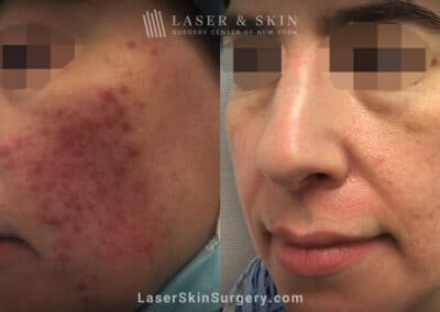 Isolaz laser, Photodynamic therapy, and Fraxel laser used to treat facial acne