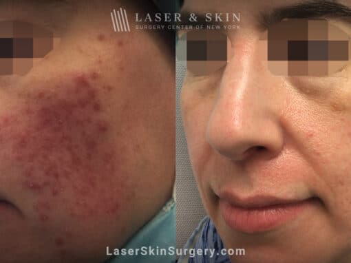 Isolaz laser, Photodynamic therapy, and Fraxel laser used to treat facial acne