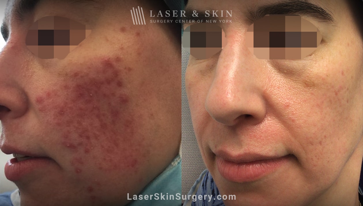 Isolaze-laser-to-treat-acne-one-treatment-LSSC-NYC Before and after images, laser treatment for acne, NYC, NY.