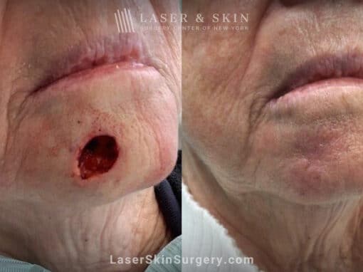 Mohs surgery to remove skin cancer on chin